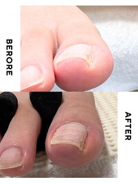 【美爪育成】《フット》巻き爪