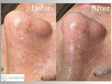 ミラー(MIRROR)/熊本市/毛穴洗浄/西熊本/くすみ