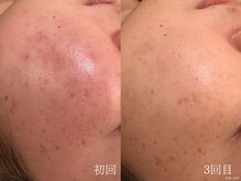 ウォーム(warm)/乾燥/敏感肌/赤み/フェイシャル