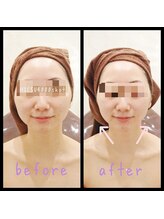 デジール(DESIR)/SPEED小顔フェイシャル4000shot