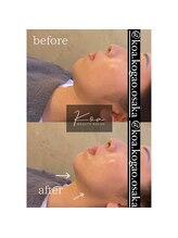 コア 心斎橋 堀江店(koa)/お客様ビフォーアフター