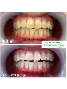 ホワイトニングサロン 名古屋駅店/【ホワイトニング施術例】