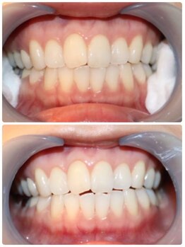 サン(SAN)/ホワイトニングB/A