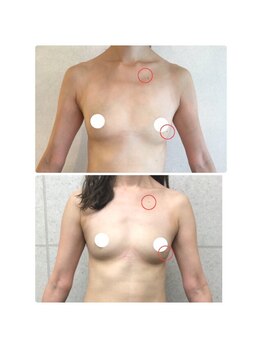 ルフルリール(Refleurir)/◆バストアップ症例/育乳◆