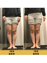 ベル/【20代会員様】O脚矯正の変化