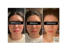 キュープ 静岡店(Qpu)/小顔矯正初回→4回→10回の変化