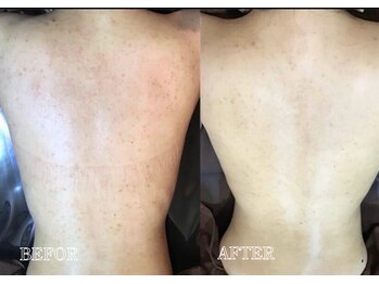 リス ブラン(Lys Blanc)/ハーブピーリング背中ＣＡＲＥ