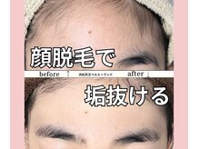 ベルミーランド 浜松天王/脱毛Before→After