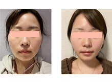 ラグラン銀座メディカルエステ 高輪ゲートウェイ店/ 小顔施術のお写真