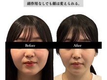 アロエベル(aloe Belle)/Before After（4回施術）