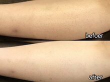 カシェット(cachette)/従来の3/1の施術期間でツヤ肌♪