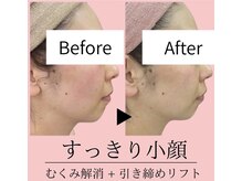 サロン ヌーク(salon Nook)/リフトアップ・小顔