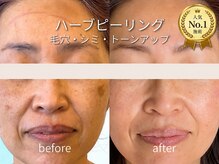 デディア(dedia)の雰囲気（毛穴の黒ずみやシミでお悩みの方はハーブピーリングをぜひ/小顔）