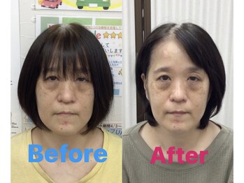 ふたば接骨院 豊橋/美容鍼ですっきり!