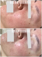 ブライトリー(Brightly)/肌質改善５回目ビフォーアフター