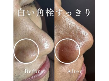 デェア コミータ/ハイドロフェイシャル