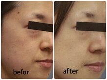 エミー(emy)/江坂/毛穴/ハーブピーリング