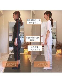 サンテリア(Santelia)/反り腰猫背姿勢矯正