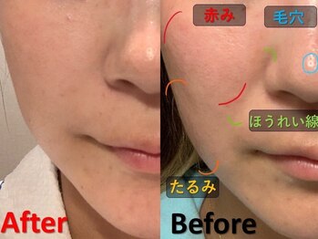 ゴールデンケア 岡崎店(Golden Care)/シミ・毛穴洗浄・フェイシャル