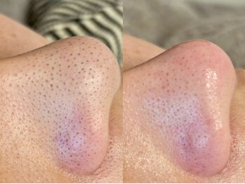 アイラッシュサロン ココ(CoCo)/毛穴エクストラクションプロ