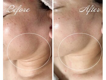 ビップフィール(vip feell)/シュっとした輪郭に★小顔ケア