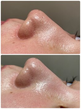 パルティール 新宿東口店 partir/ハイドロ毛穴洗浄でゴッソリ