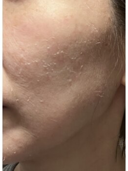 リセス(Recess)/ハーブピーリング