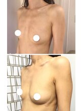 美人バスト 浦和店/【バストアップ★育乳】症例