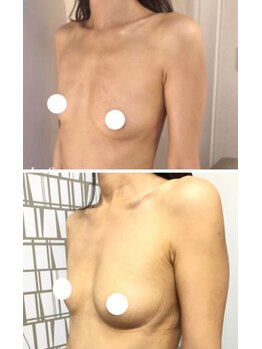 美人バスト 浦和店/【バストアップ★育乳】症例