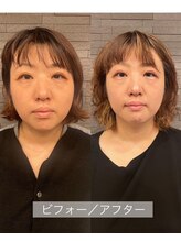 長寿鍼灸院 長寿整骨院/ハリネズミ女優美容鍼効果★