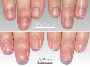 自爪育成・深爪改善コース