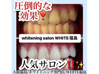 ホワイトニングサロン ホワイト(WHITE)/セルフホワイトニング/大阪/福島