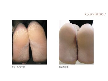 アンジュロワール/かかとピールトリートメント