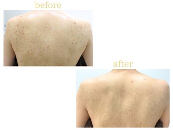 オリス 名古屋店(oliss)/リセットプログラムbefore/after