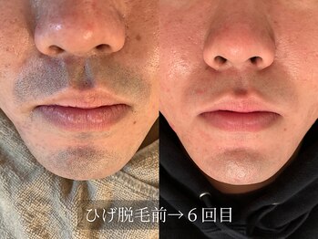 アルム(Arum)/ひげ脱毛