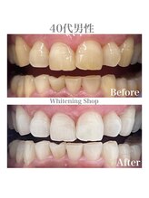 ホワイトニングショップ 広島廿日市店/before&after