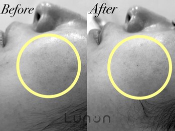 ルノン(Lunon)/ララピール