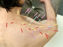 とだ鍼灸院/《鍼施術》首肩こりレスキュー鍼