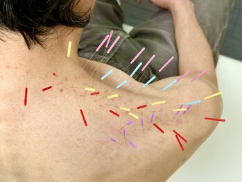 とだ鍼灸院/《鍼施術》首肩こりレスキュー鍼