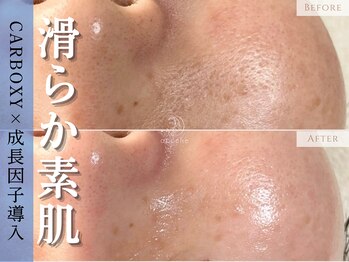 アポシェ(apoche)/開き毛穴/詰まり/くすみ/ハリ