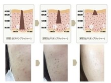 ニコ ウィズ(Nico with)/シミケア