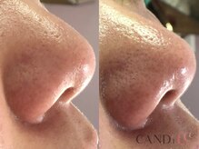 キャンディ 岐阜(CANDi)/ハイドラピーリング/黒ずみ毛穴