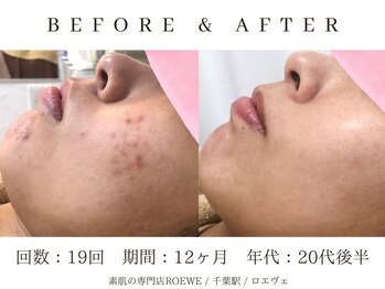 ロエヴェ(ROEWE)/ニキビ改善・毛穴ケア・肌質改善