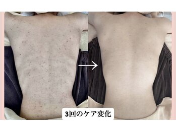 スキンハピネス(skinhappiness)/背中ハーブピーリング