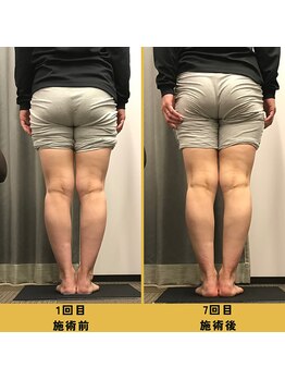 ベル/【20代会員様】O脚矯正の変化