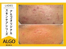 アルゴ 越前店(ALGO)/エステ×脱毛
