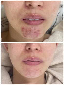 ニキビケア研究所 吉祥寺店/繰り返す顎ニキビも◎