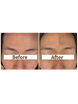 ミラ(Mila)/お肌の変化!BeforeAfter