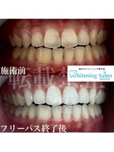 ホワイトニングサロン 福岡天神店/ホワイトニング