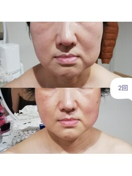 RiとBiのたまご/（フェイシャル）レモンボトル